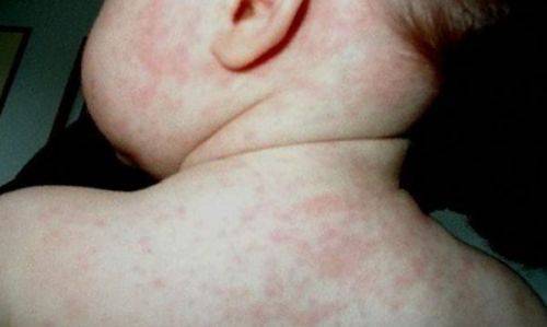 Герпес у детей: виды вируса, симптомы заболеваний, лечение и профилактика