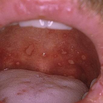 Лакунарная ангина у детей - лечение и симптомы заболевания с фото