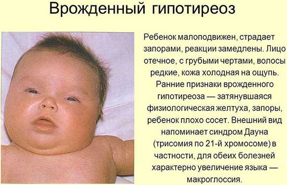 Ожирение у детей разной степени: фото, таблица по возрасту, профилактика и лечение