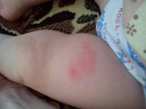 Ребенка укусила собака: что делать в домашних условиях, нужна ли прививка от столбняка?