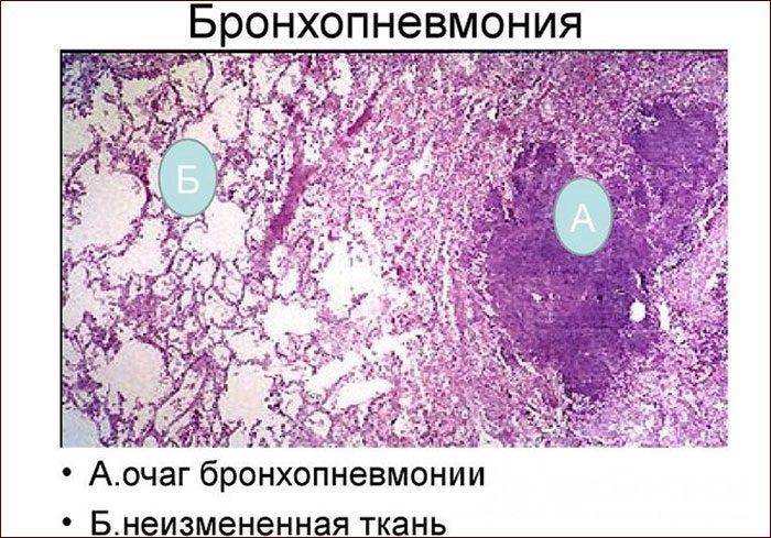 Капли от насморка для детей от года: лучшие спреи, противовирусные средства в нос