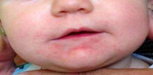 Сыпь на подбородке у ребенка: раздражение от слюней, аллергия и другие причины (фото с пояснениями)