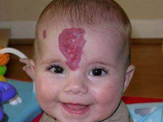 Когда у детей появляются родинки: в каком возрасте, можно ли удалять, к кому обратиться?