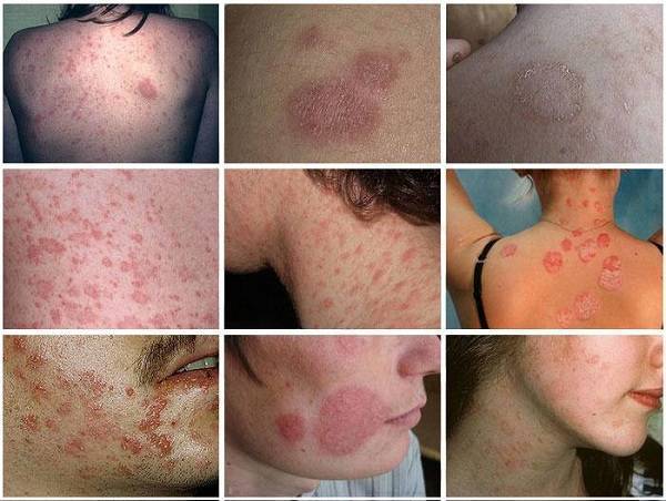 Розовый лишай у ребенка: фото, признаки и лечение в домашних условиях