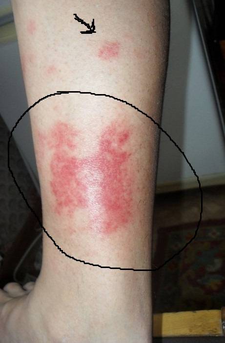 Шершавые пятна на теле у ребенка (на коже ног и рук, на спине и лице): фото