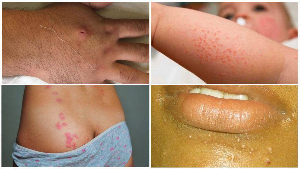 У ребенка после укуса комара появились шишки - что делать и как лечить большие припухлости?