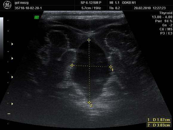 НСГ головного мозга новорожденных и детей до года: что показывает УЗИ (нейросонография)?
