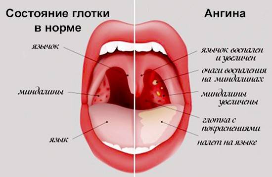 Золотистый стафилококк в горле у ребенка: лечение и симптомы бактерий в мазке из зева