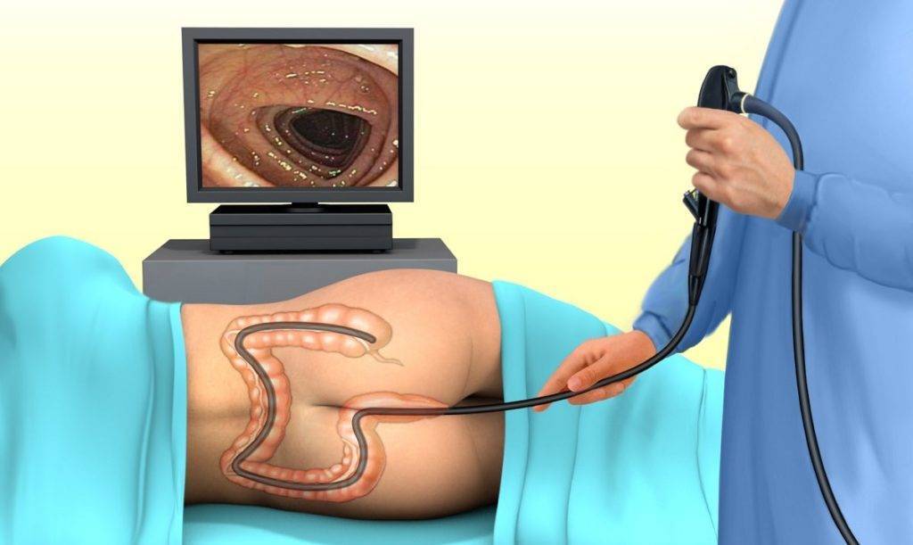 Долихосигма кишечника у ребенка - что это такое, каковы симптомы и лечение болезни?