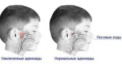 Гайморит у детей: симптомы и лечение в домашних условиях антибиотиками и народными средствами