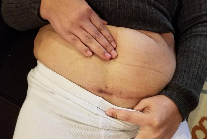 Почему после кесарева сечения на шве может появиться уплотнение, что делать?