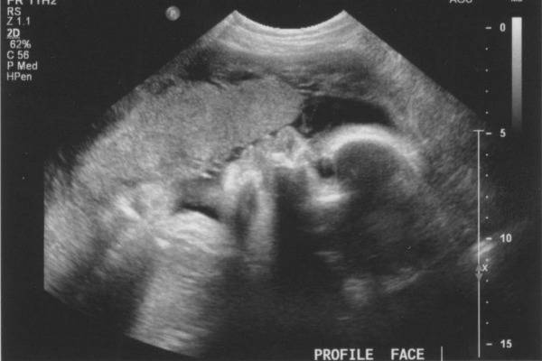 УЗИ на 34 неделе беременности: показатели нормы у плода и будущей матери