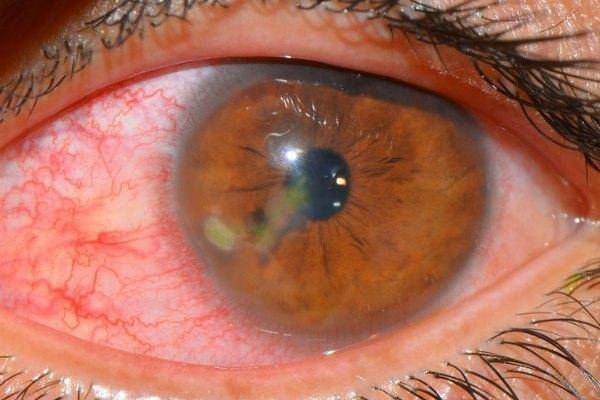 У ребенка красные глаза: причины и лечение, сопутствующие симптомы - гной, аллергия