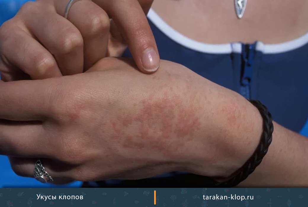 Укусы клопов у детей: фото, симптомы с описанием следов на теле малыша