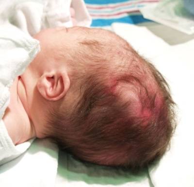 Родовая травма новорожденных: последствия повреждения шейного отдела позвоночника и головы