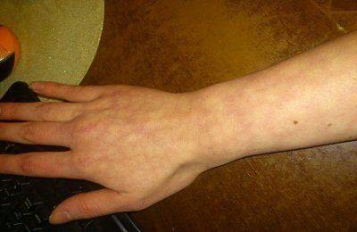 Мраморная кожа у грудничка: причины мраморности кожных покровов и лечение