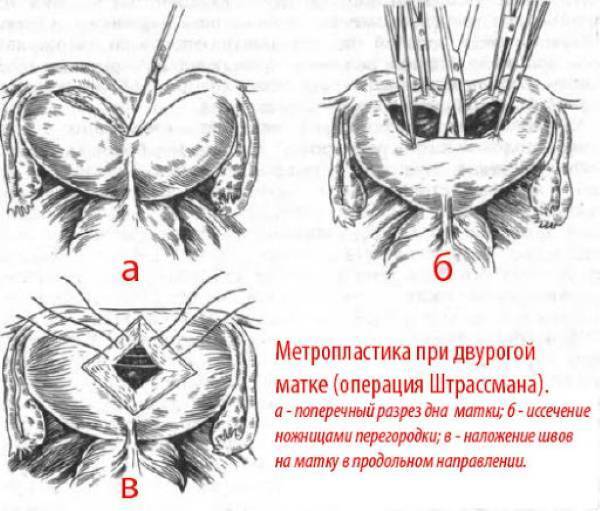 Седловидная матка: что это значит и какие еще есть виды, можно ли забеременеть?