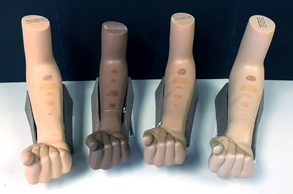 Как уменьшить Манту на руке в домашних условиях - можно ли мазать "Фенистилом" и другими средствами?