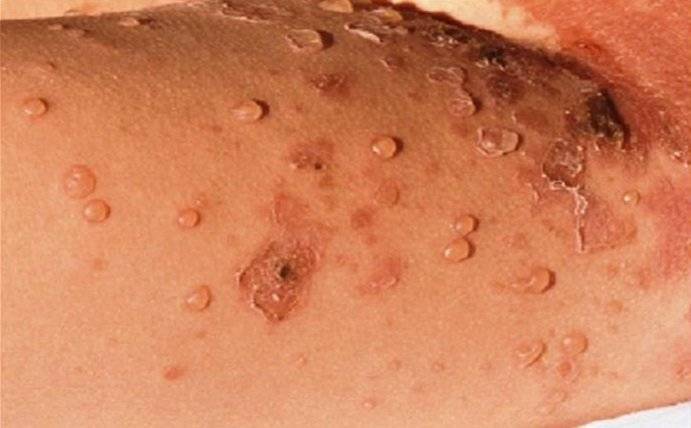 Везикулопустулез у детей - фото патологии у новорожденных, симптомы, причины, лечение