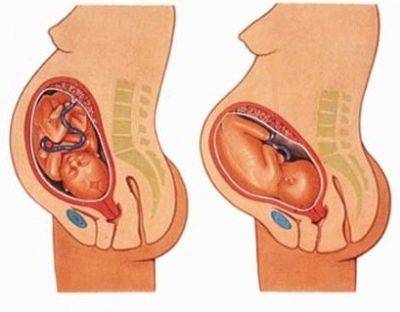 Как понять, что опустился живот перед родами: на какой неделе происходит опущение, когда рожать?
