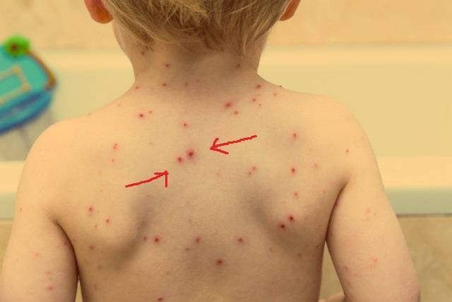 Шершавые пятна на теле у ребенка (на коже ног и рук, на спине и лице): фото