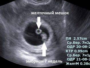 Желточный мешок: норма по неделям беременности, размеры на ранних и поздних сроках