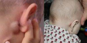 Лимфоузлы при ветрянке у детей: причины воспаления и появления шишек за ушами