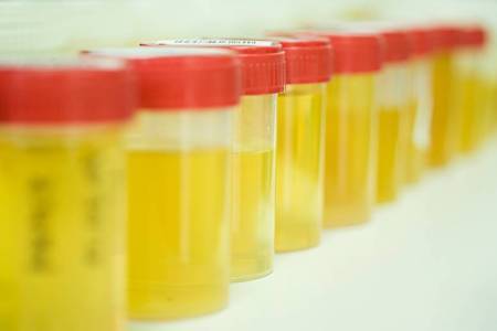 Анализ мочи по Зимницкому для детей: сбор материала, норма и расшифровка результатов