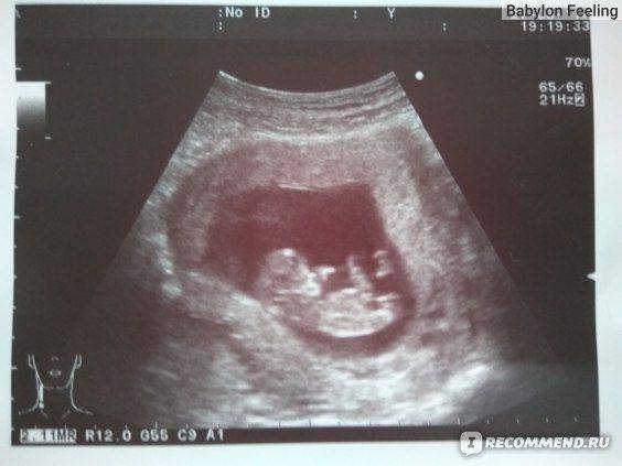 Неинвазивный тест Пренетикс: что можно кушать перед исследованием