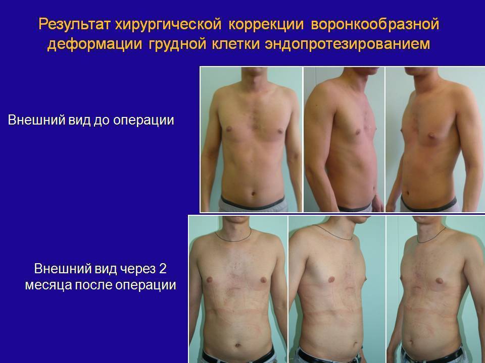 Килевидная грудная клетка (куриная грудь): признаки и лечение