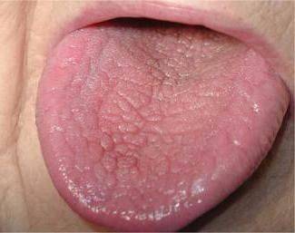 Сухость во рту у детей - причины дискомфорта, способы лечение ксеростомии