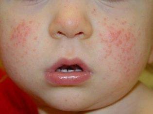 Сыпь у ребенка на попе - фото прыщей с пояснениями, причины аллергии и сухой кожи, лечение
