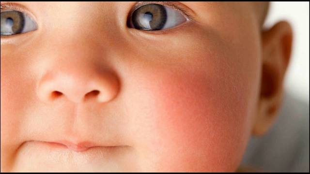 Аллергия на молоко у ребенка: симптомы, фото непереносимости белка у грудничка