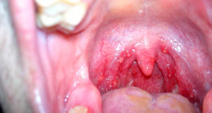 Стоматит в горле у ребенка (с фото): способы лечения язвочек на миндалинах