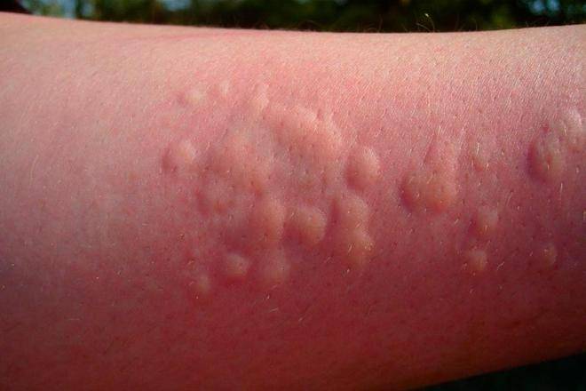 Пневмококковая прививка от инфекции детям до года: реакция, график вакцинации, побочные действия