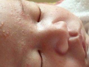 Сыпь у ребенка на попе - фото прыщей с пояснениями, причины аллергии и сухой кожи, лечение