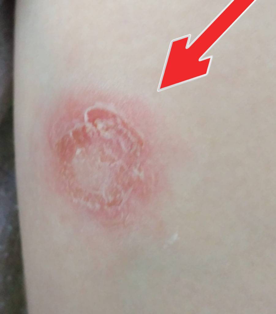 Шершавые пятна на теле у ребенка (на коже ног и рук, на спине и лице): фото