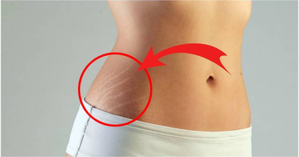 Масло от растяжек от bio oil - косметическое средство от шрамов и неровного тона кожи