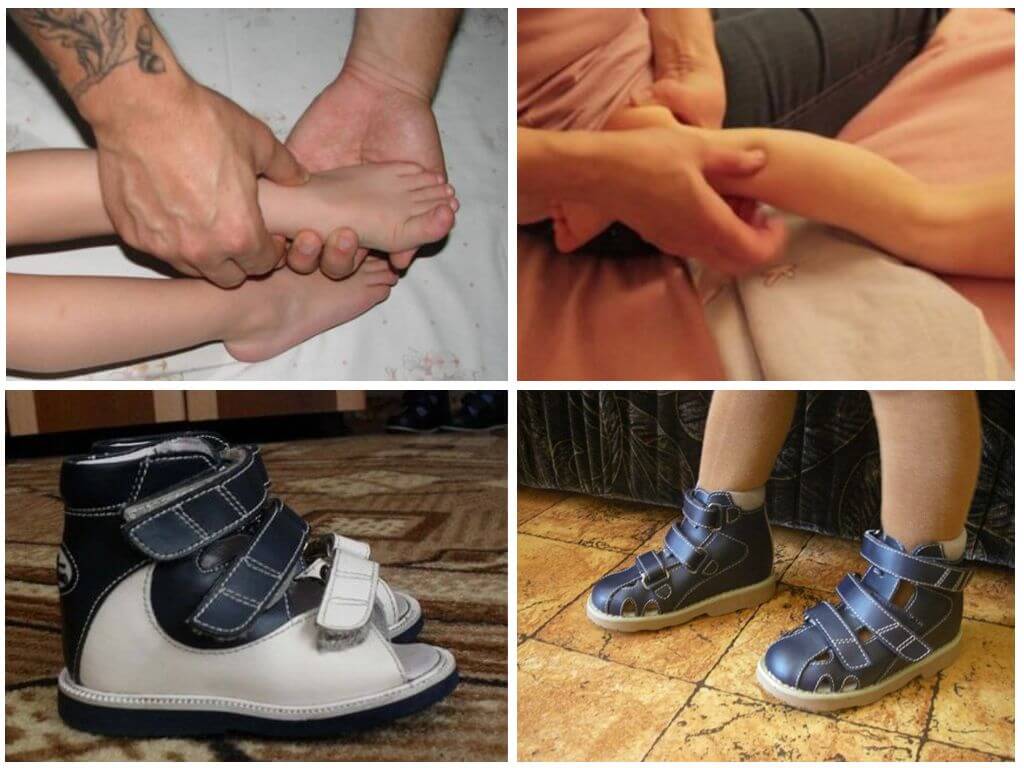 Варусная деформация стопы у детей ???? - фото и симптомы, способы лечения, подбор обуви