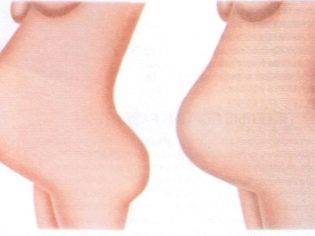 Как понять, что опустился живот перед родами: на какой неделе происходит опущение, когда рожать?