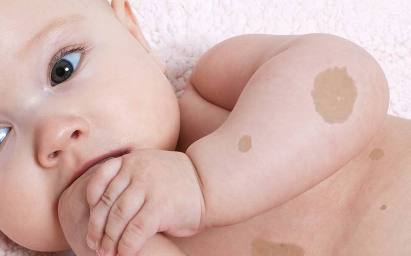 Когда у детей появляются родинки: в каком возрасте, можно ли удалять, к кому обратиться?