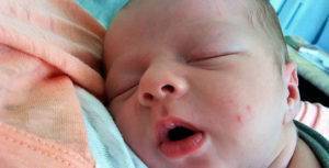 Прыщики на лице у новорожденного в 1 месяц - белые, красные (на щеках, лбу, голове)