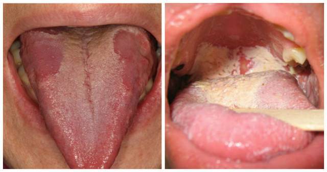 Симптомы грибковой ангины у детей и лечение инфекции противогрибковыми препаратами