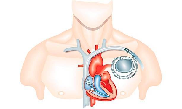 Что такое кардиопатия и кардиомиопатия у детей: причины, симптомы и лечение