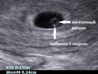 Желточный мешок: норма по неделям беременности, размеры на ранних и поздних сроках