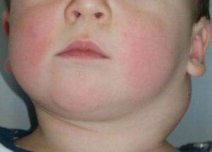 У ребенка опухла шея с одной стороны под ухом: причины, сопутствующие симптомы и лечение