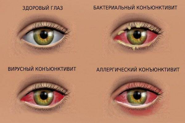 У ребенка красные глаза: причины и лечение, сопутствующие симптомы - гной, аллергия
