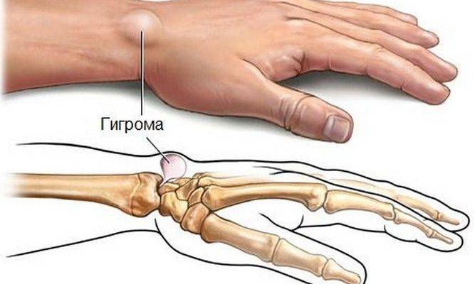 Шишка на ноге у ребенка сбоку стопы: фото гигромы и других образований