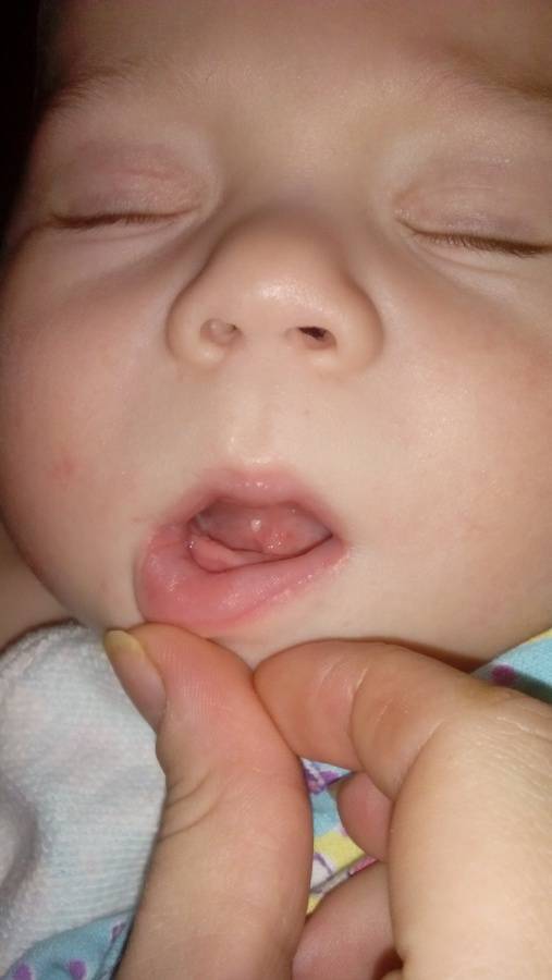 Стоматит на языке у ребенка: фото, лечение язвочек во рту, профилактика