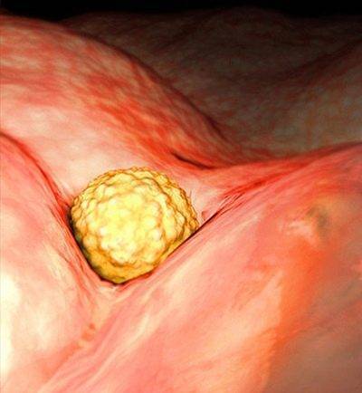 Имплантационное кровотечение: на какой день после зачатия наступает, как отличить от месячных?